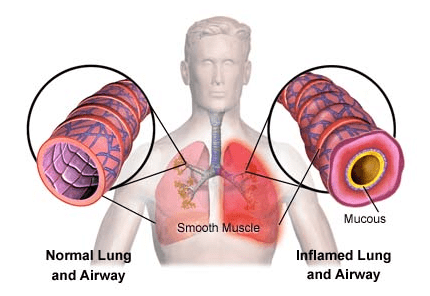 is bronchitis contagious after you begin taking antibiotics
