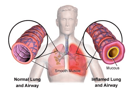 bronchitis cough contagious